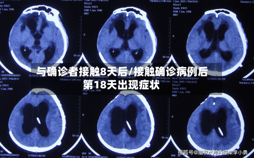 与确诊者接触8天后/接触确诊病例后第18天出现症状